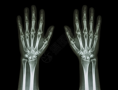 手臂骨骼X光手前视 普通人手x射线手术疾病医院前臂保健男人手指医生病人背景