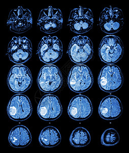 左脑右脑MRI 大脑 右脑叶上的脑瘤脑血管断层核磁共振医院肿瘤保健x射线扫描手术病人背景