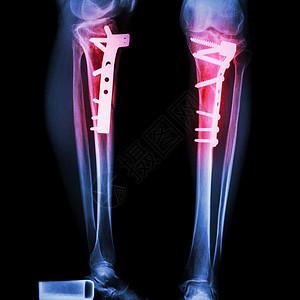 四肢骨折腿骨胫骨骨科卫生蓝色股骨盘子病人x光x射线手术背景图片