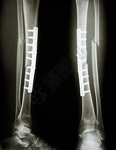 裂脚亚目蒂比亚和纤维骨裂轴临床辐射手术医院骨科盘子创伤腓骨诊断科学背景