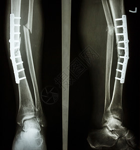 裂脚亚目蒂比亚和纤维骨裂轴疼痛骨骼电影考试临床手术解剖学碰撞疾病骨科背景