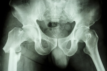 碎骨头右腿骨高处的骨头科学骨骼男人x射线电影疼痛创伤保健骨科大腿背景