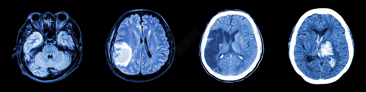 右侧人素材脑部和多种疾病右侧 正常大脑 脑肿瘤 肠道进化 内部跟踪出血的CT采集扫描男人中风神经外科科学断层增值税保健事故卫生背景