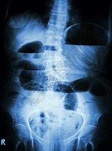 肠胃气胀小肠梗阻 腹部正位 X 光片 由于小肠梗阻 显示小肠扩张和小肠气液平面背景