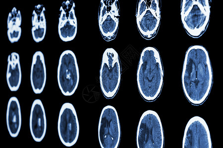 肠出血性脑显示化学中风缺血和出血的薄膜CT扫描断层神经事故保健科学放射科医院诊断颅骨射线背景
