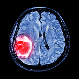 脑癌MRI 大脑 显示脑部右皮层叶的脑肿瘤治疗麻痹电影卫生射线病人医生保健外科x射线背景