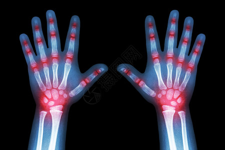 风湿性关节炎儿童手和多联关节炎X光掌骨方阵骨科腕骨x射线棕榈保健射线婴儿手指背景图片