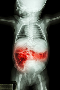 肠炎对生病婴儿的X光和肠炎儿科放射科孩子新生儿x光器官解剖学疾病卫生病人背景图片