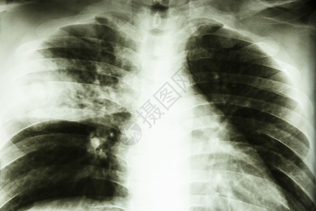 分枝杆菌洛巴肺炎疾病射线诊断医师卫生骨骼药品诊所感染辐射背景