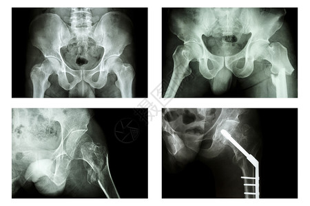 骨盆骨折X射线薄膜骨折股骨(高处骨骨) 是手术和内部固定骨骼背景