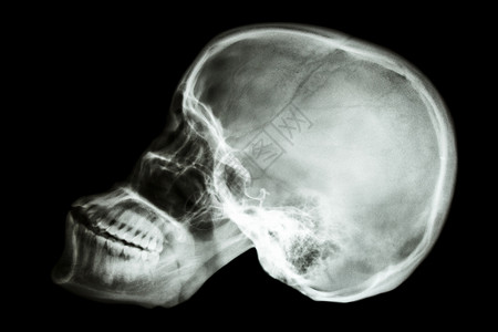丑陋头骨亚述人头骨泰国人颅骨保健放射科身体电影药品脖子死亡解剖学男人背景
