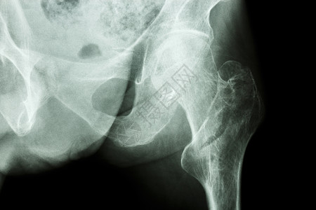 不幸的事左大腿骨断裂痛苦考试疾病病人射线情况腰部男人卫生电影背景