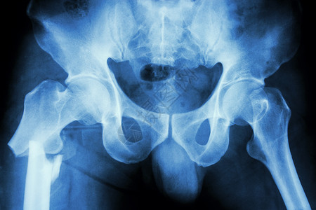 碎骨头右腿骨高处的骨头解剖学病人蓝色扫描射线医院骨盆大腿碰撞x射线背景