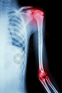 肩椎炎左肩部和肩及肘部关节炎保健男人药品身体卫生肱骨骨科肩胛骨骨骼疾病背景