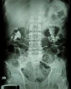 尿路结石双边肾上钙角药品外科射线泌尿科诊断空白病人系统肾脏脊柱背景