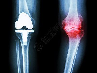 x型腿骨眼关节炎病人和人工关节的膝部成形术疾病假肢衰老放射科金属膝盖腓骨x光胫骨背景