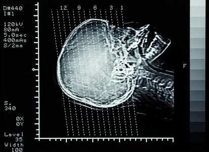 神经外科素材胶片CT扫描光谱断层摄影大脑 显示部分线电脑颅骨医院放射科卫生射线科学技术男人中风背景