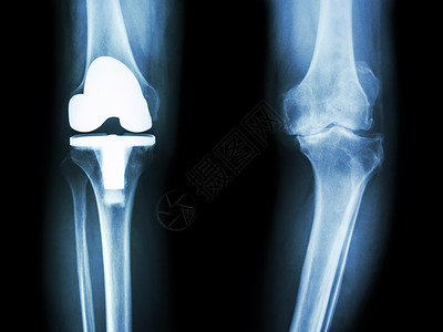 骨眼关节炎病人和人工关节的膝部男人衰老诊断疾病医生电影扫描保健x射线手术背景