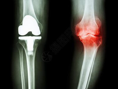 骨眼关节炎病人和人工关节的膝部腓骨骨科胫骨药品医院衰老外科金属疾病股骨背景