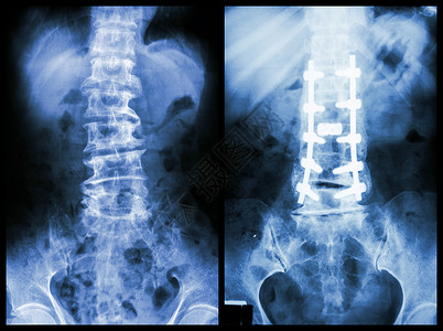 脊柱手术脊髓硬化左侧图象 病人手术和内部固定 正确图象医生骨骼治疗射线骨科扫描药品金属腰椎x光背景