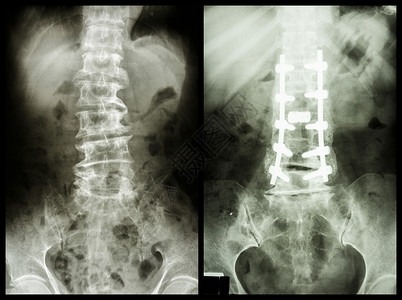 脊髓硬化左侧图象 病人手术和内部固定 正确图象脊柱诊断椎骨医生放射科疾病恶化x射线解剖学金属背景图片