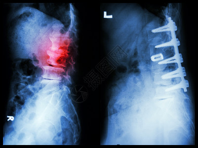 骨科手术脊髓硬化左侧图象 病人在老人身上手术和内部固定 正确图象外科男人医生射线脊柱骨骼骨科骨干脊椎治疗背景