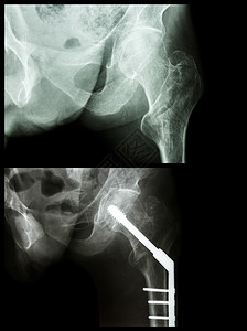 大腿骨折外形骨折左腿骨断裂的大腿骨 手术后插入了内指甲诊断药品解剖学骨骼射线治疗金属扫描x射线放射科背景