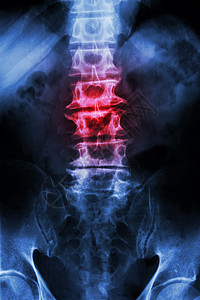 脊椎侧弯素材老年病人和脊椎炎的松发性硬化薄膜X射线LS脊椎乳液囊骨骼腹部男人外科射线骶骨保健脊椎腰椎解剖学背景