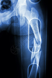 碎骨头电影X光显示科明的股骨高骨头断裂轴事故解剖学卫生药品骨科手术医生保健病人疾病背景