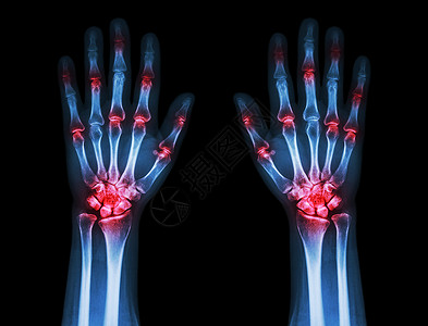 人骨骼黑色背景的双手Gout 风湿多重关节炎卫生解剖学身体药品x光痛风放射科保健外科掌骨背景