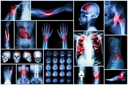 疾病人类X-射线多种疾病 中风 脑血管意外 脑血管病 肺结核 骨折 肩关节脱位 痛风 类风湿性关节炎 脊椎病 骨关节炎 肠梗阻背景