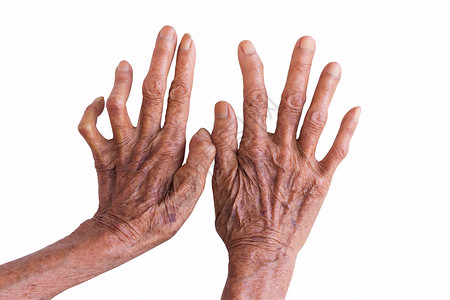 被白背景孤立的麻风病人的手高清图片