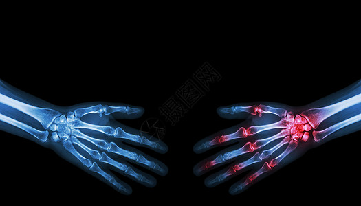 抓牢X光正常人与关节炎手动者握手卫生前臂骨科骨骼x光解剖学风湿保健药品棕榈背景