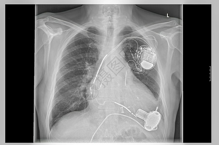 X光图像 链接 人工心脏起搏器高清图片
