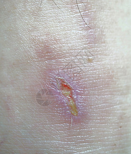 腿部溃疡疼痛的皮肤高清图片