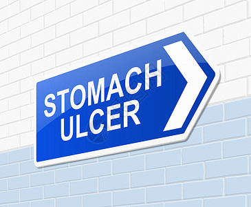 胃溃疡概念治疗肠胃医院插图医疗蓝色溃疡背景图片