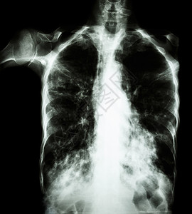肺肺结核薄膜胸透 由于Mycobactium结核病感染 间歇性渗入两个肺部解剖学感染药品x射线疾病肺泡传播诊断躯干结核病背景