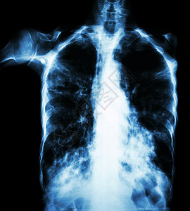 肺肺结核薄膜胸透 由于Mycobactium结核病感染 间歇性渗入两个肺部肋骨扫描肺泡蓝色肺炎纤维化x光x射线疾病药品背景