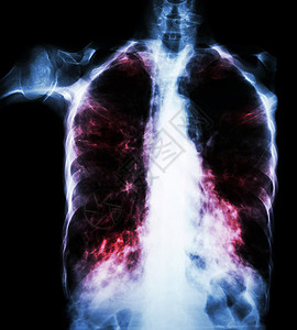 肺肺结核薄膜胸透 由于Mycobactium结核病感染 间歇性渗入两个肺部药品纤维化男人细菌蓝色x射线传播结核病扫描诊断背景