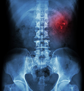 肾结石 肾结石 肾结石 拍片 X 光 KUB 肾输尿管膀胱 显示左肾结石树干医生尿液石头躯干腰部腹部病人疼痛脊柱背景图片