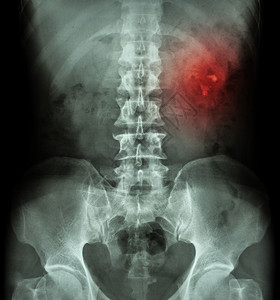 泌尿结石肾结石 肾结石 肾结石 拍片 X 光 KUB 肾输尿管膀胱 显示左肾结石疾病解剖学肾脏腰部骨盆医生椎骨外科扫描尿液背景