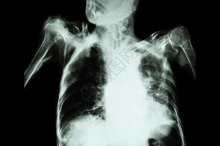 乳杆菌素急性呼吸系统衰竭旧病人的乳胸X光片显示肺动脉和通过内径切耳管透入肺部并同时渗入内侧胃管的肺道肺结核疾病肺炎传染性气管胸部骨骼身体背景