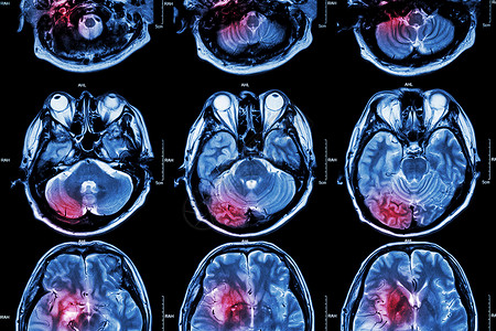大脑疼痛大脑 中风 脑肿瘤 脑梗塞 脑出血 的胶片 MRI 磁共振成像 医学 保健 科学背景 大脑横截面背景