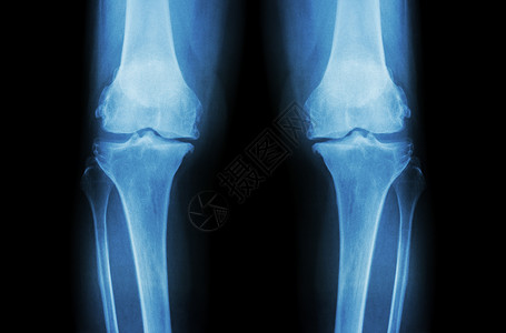 膝骨关节炎 OA 膝 双膝 X 光片 前视图 显示关节间隙狭窄 关节软骨丢失 骨赘 软骨下硬化大腿科学骨科疗法整骨外科诊断医院药背景图片