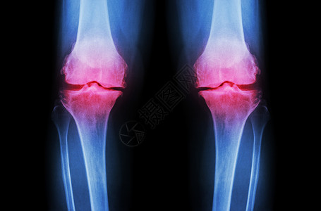 丢失东西膝骨关节炎 OA 膝 双膝 X 光片 前视图 显示关节间隙狭窄 关节软骨丢失 骨赘 软骨下硬化疼痛腓骨疗法药品科学医院整骨手术身背景