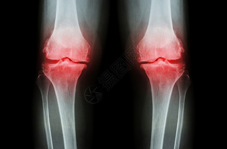 强壮骨骼膝骨关节炎 OA 膝 双膝 X 光片 前视图 显示关节间隙狭窄 关节软骨丢失 骨赘 软骨下硬化胫骨医生x光疾病双胞胎电影疼痛身体背景