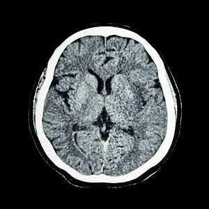 脑部CT扫描 显示正常人的大脑CAT扫描事故疾病电脑断层创伤轴向中风手术神经电影背景图片
