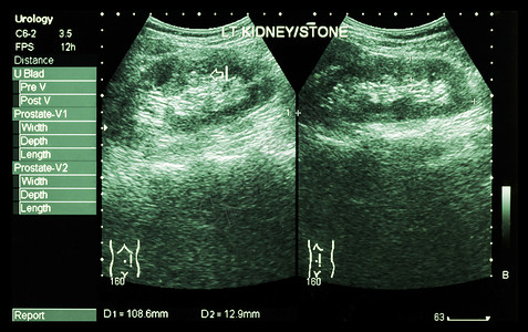 泌尿结石肾的超声波分析 显示左肾结石2张图象比较调查放射科扫描保健肾脏医生海浪腹部检查考试背景
