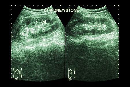 泌尿结石肾的超声波分析 显示左肾结石2张图象比较电影医生调查腹部放射科保健检查回声疾病石头背景