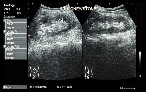 泌尿结石肾的超声波分析 显示左肾结石2张图象比较腹部回声手术电影双胞胎卫生石头肾脏检查扫描背景